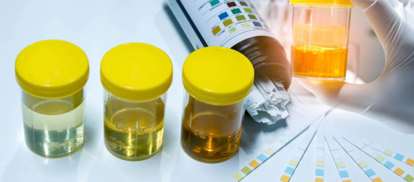 Θολά ούρα: Τι πρέπει να γνωρίζετε – Οι πιο πιθανές αιτίες